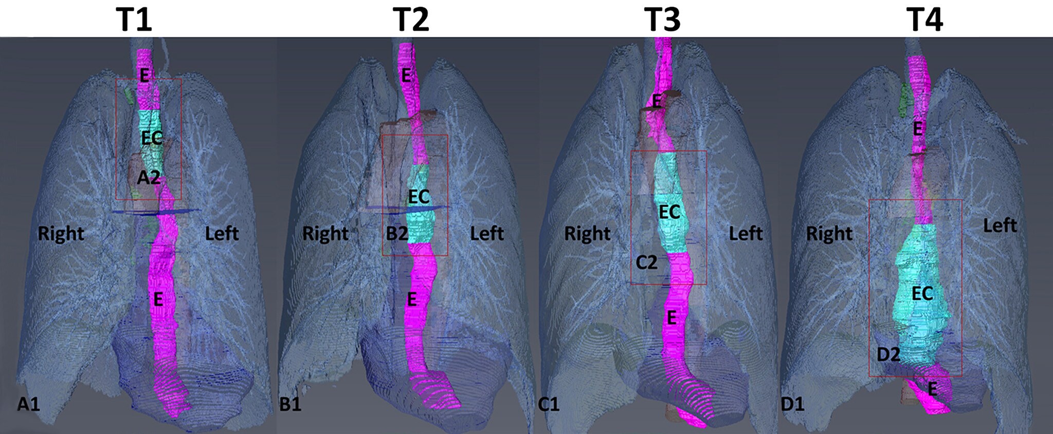 Esophageal cancer tumor progression at different T-stages, reconstructed with Amira Software