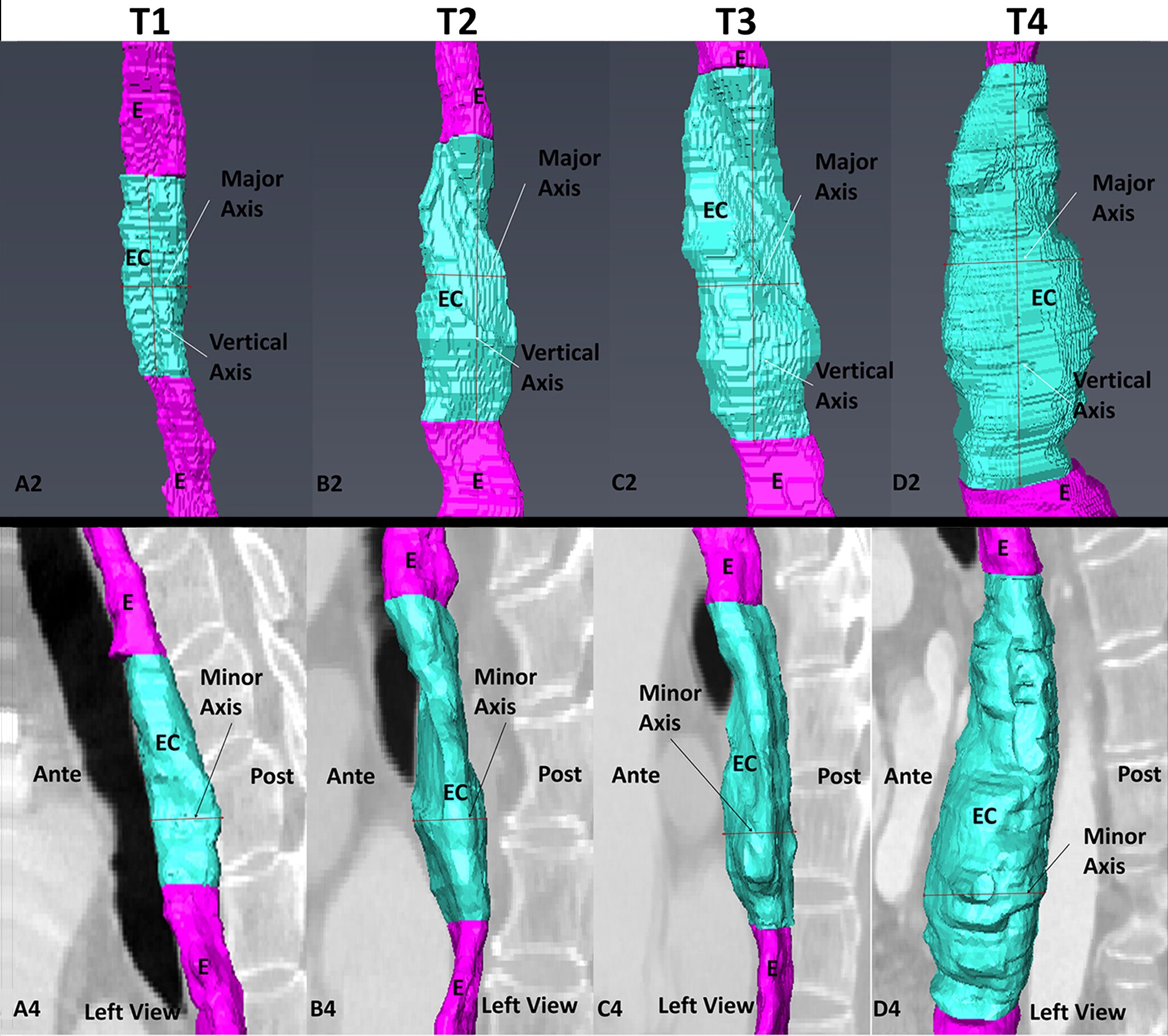Major and minor axes of esophageal cancer tumors at different T-stages, reconstructed with Amira Software.