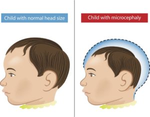 microcephaly