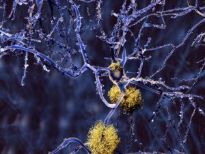 alzheimers-plaques