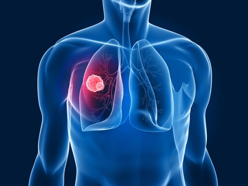 Lung cancer. Image: Sebastian Kaulitzki/Shutterstock.com