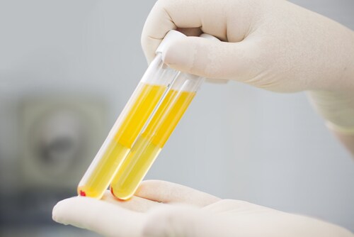 Plasma samples in test tube. Image: Fly_dragonfly/Shutterstock.com
