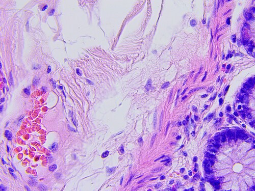 Colon cancer microscopic photograph. Image: dzika_mrowka/Shutterstock.com.