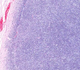 Microscopic view of oligodendroglioma of the brain (right half in blue) and normal brain (pink portion on left). The brain cancer has invaded and replaced normal healthy brain tissue. Glioma of brain. Image: vetpathologist/Shutterstock.com..