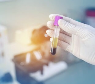 Blood in tube laboratory. Image: Janthiwa Sutthiboriban/Shutterstock.com.