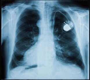 Most pacemakers contain at least two platinum-iridium electrodes.