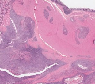 Endometriosis - image illustrates uterine endometrium infiltrating the intestinal wall