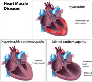 cardiomyopathies