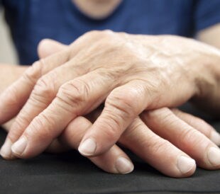 Hands affected by rheumatoid arthritis. Image: Hriana/Shutterstock.com