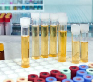 Rack with several urine samples. Image: angellodeco/Shutterstock.com