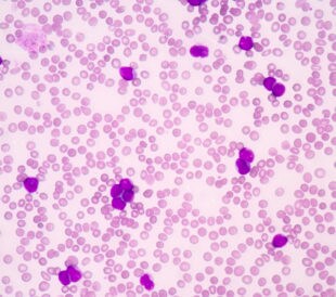Blood smear showing acute myeloblastic leukemia (AML)