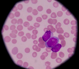 Acute myeloid leukemia. Image: toeytoey/Shutterstock.com