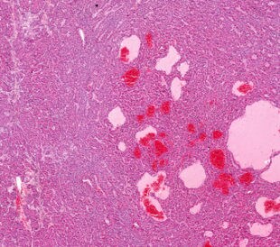 Hepatocellular carcinoma in liver tissue. Image: vetpathologist/Shutterstock.com