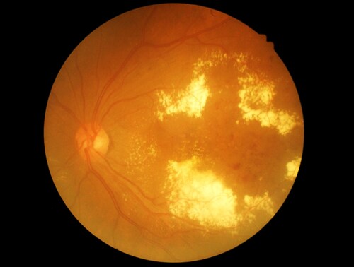 Image result for diabetic retinopathy