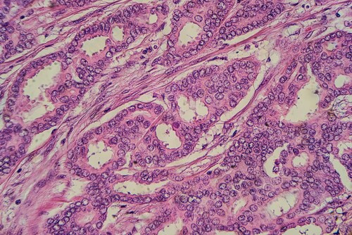 Breast cancer histology: Microscopic image of a well differentiated, grade 1, infiltrating (invasive) ductal carcinoma (photographed and uploaded by US board-certified surgical pathologist). Image: David Litman/Shutterstock.com.