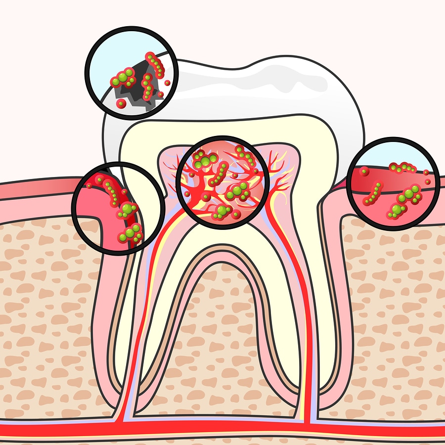 Endodontic Disease