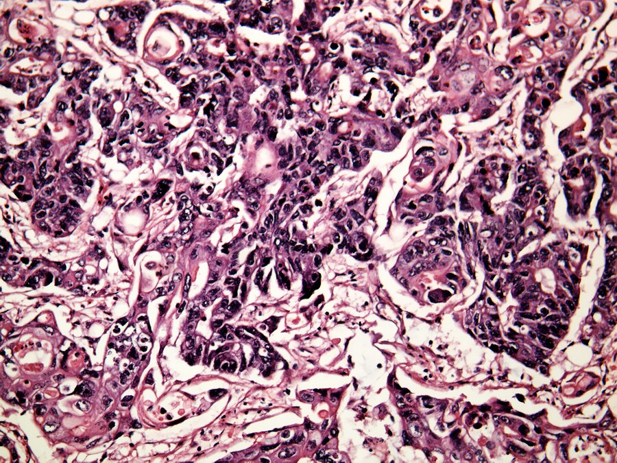 Liver cancer cells