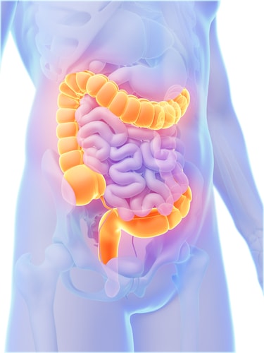colon cancer