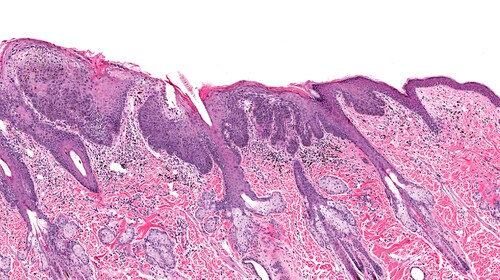 squamous cell carcinoma in situ histology