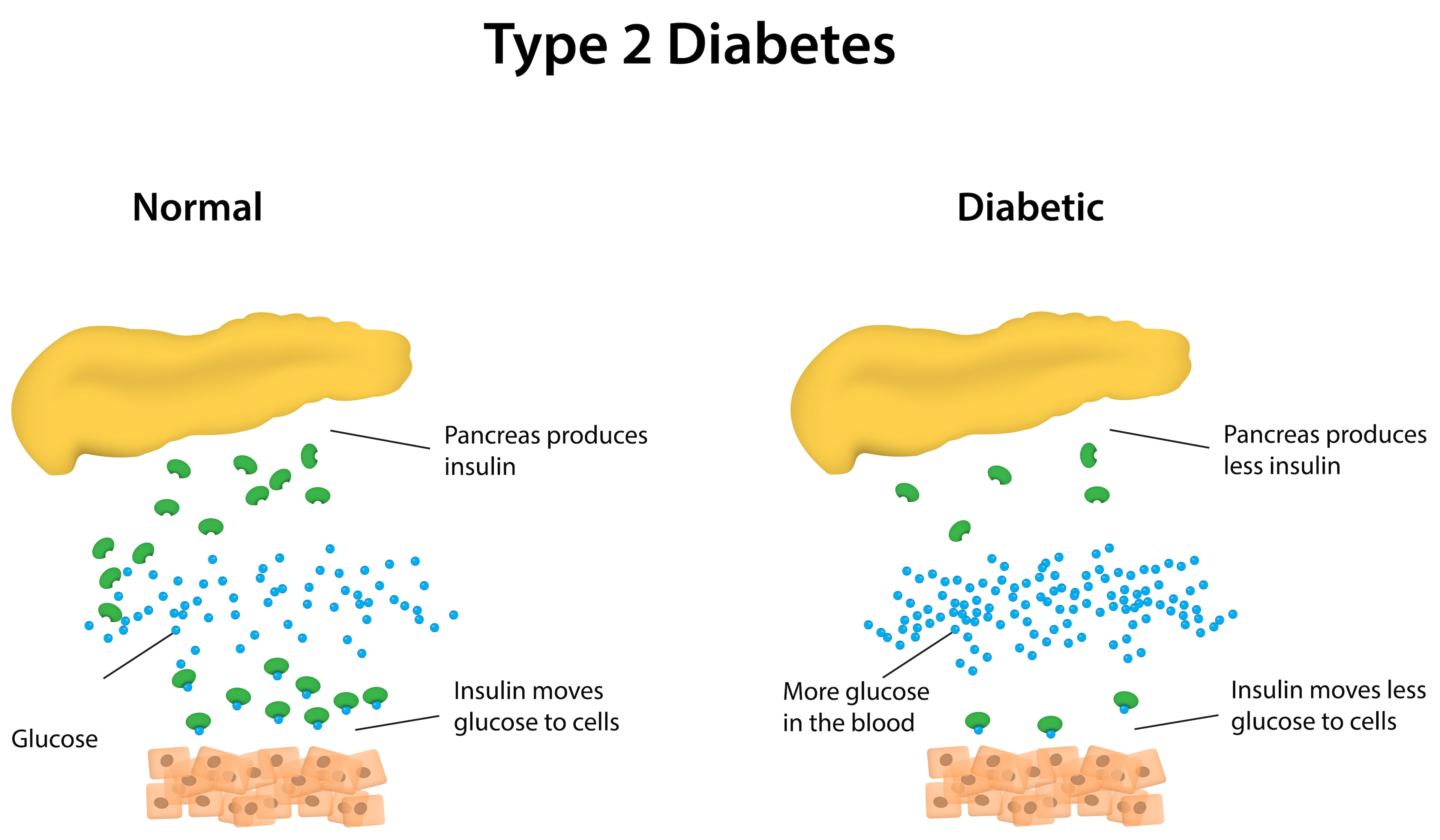 low insulin production in type 2 Diabetes