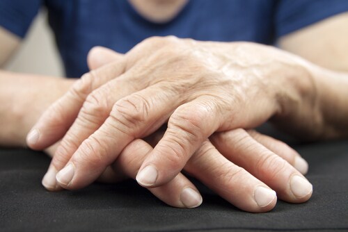 Hands affected by rheumatoid arthritis. Image: Hriana/Shutterstock.com