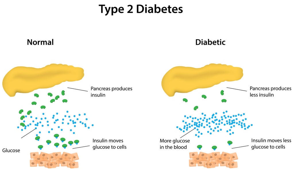 research on type 2 diabetic