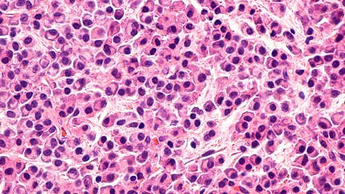 Myeloma awareness: Microscopic image of bone biopsy showing multiple myeloma, a type of bone marrow cancer of malignant plasma cells. It is associated with bone pain, bone fractures and anemia. Image: David Litman/Shutterstock.com.