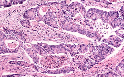 Colon cancer: Photomicrograph (microscopic image) of an invasive colonic adenocarcinoma. Screening colonoscopy can detect precancerous polyps (adenomas) and prevent colon cancer. Image: David Litman/Shutterstock.com.