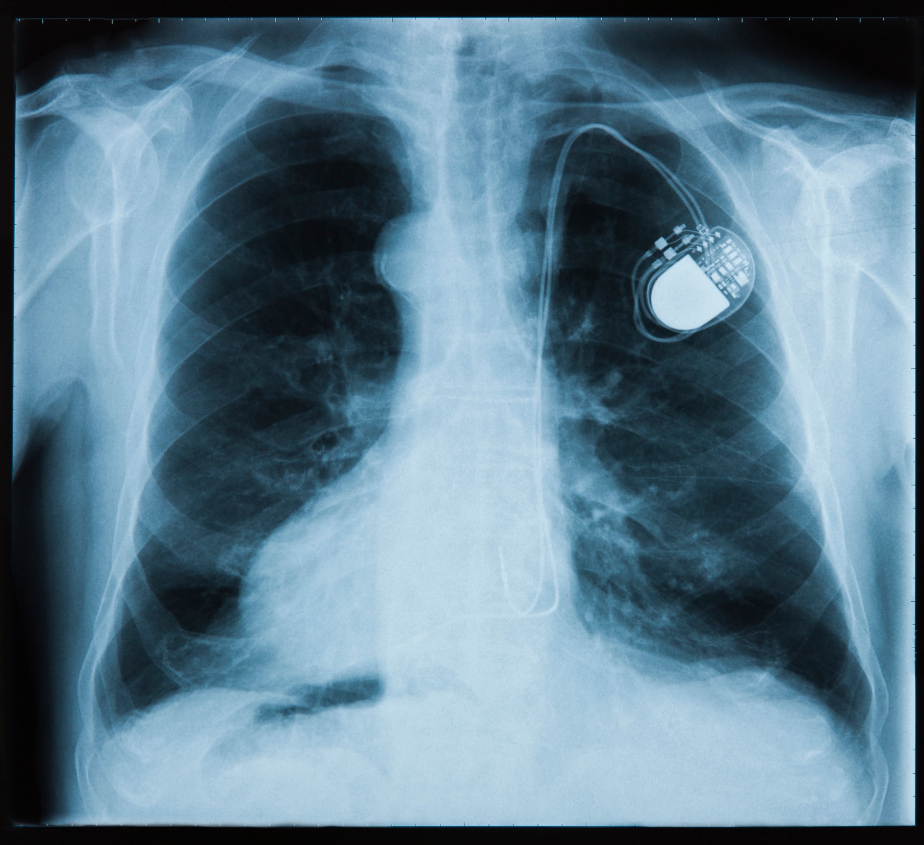 Most pacemakers contain at least two platinum-iridium electrodes.