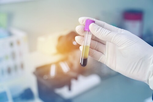 Blood in tube laboratory. Image: Janthiwa Sutthiboriban/Shutterstock.com.