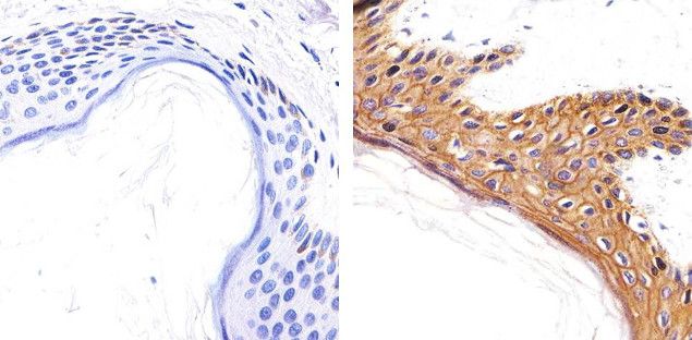 breast cancer metastatic to brain symptoms