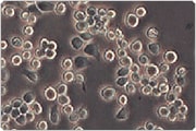 Round lymphoblastic cells on a contrasting background in a sporadic pattern