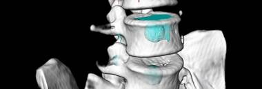 Vertevrae_Segmentation_380x130 Vertevrae_Segmentation_380x130