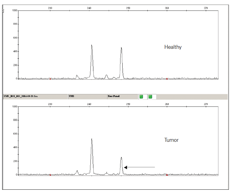 Detecting Loss of Heterozygosity Electropherogram of a microsatellite marker in DNA
