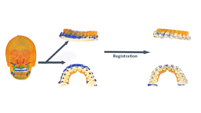 Maxilla in postoperative position compared to the maxilla of the virtual planning Maxilla in postoperative position compared to the maxilla of the virtual planning