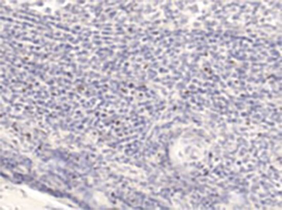 Foxp3 Human Tonsillar IHC Staining Foxp3 Human Tonsillar IHC Staining