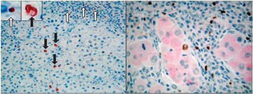 Foxp3 Lymphocyte and Tumor Cell Staining Foxp3 Lymphocyte and Tumor Cell Staining