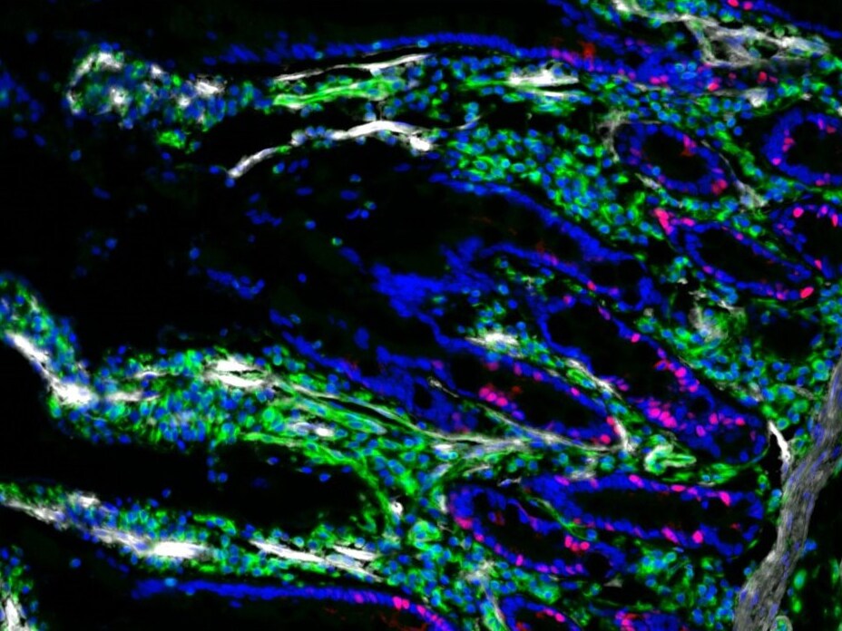 3-plex Aluora reagents in small intestine Image of 9-plex Aluora Spatial Amplification labeling in human invasive ductal carcinoma
