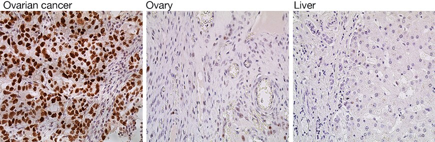 Detection of relative p53 expression by IHC Detection of relative p53 expression by IHC
